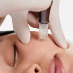 Vue rapprochée d'un soin nanoneedling sur la peau d'une femme. Soin Pro Nanoneedling Dermalogica chez Bodysphere à Grenoble et Vif et Crolles
